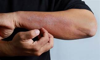 How to Avoid Steroids When You Have Eczema