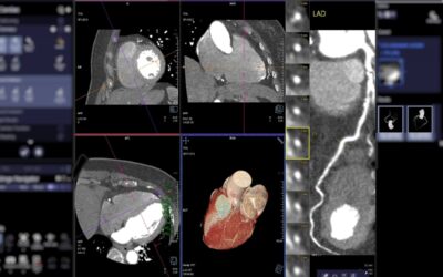 Detect Heart Disease Early with a Cleerly CT Scan