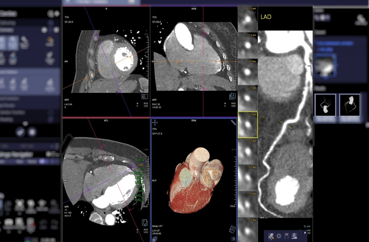 CTA Coronary artery 3D rendering image on the screen for diagnosis of vessel coronary artery stenosis .