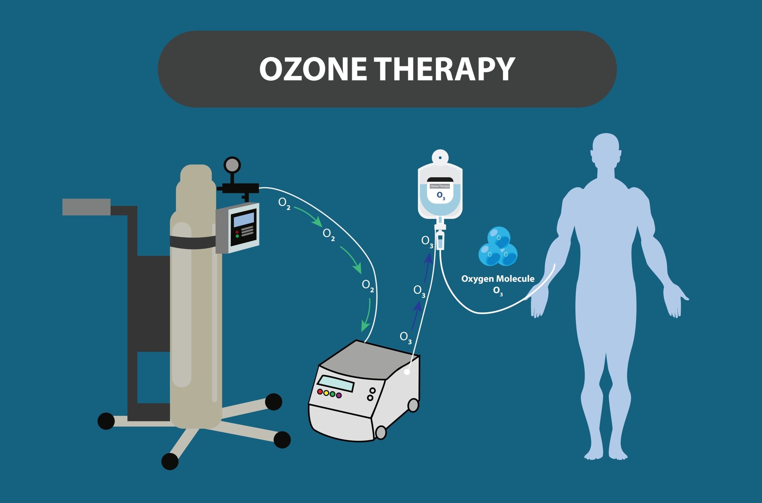 Ozone Therapy IV Explained Vector